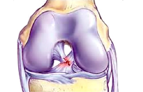 Knee ACL Reconstruction Surgery